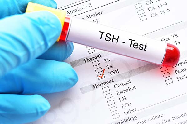 تفسیر آزمایش TSH