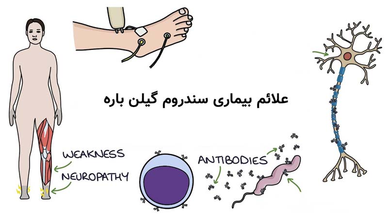 علائم بیماری سندروم گیلن باره