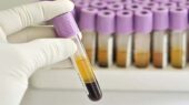 آزمایش Creatinine چیست ؟ تفسیر آزمایش Creatinine خون