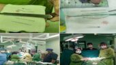پزشکان 4 سوزن خیاطی را از قلب یک زن خارج کردند