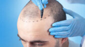 کلینیک های کاشت مو در شیراز