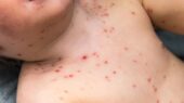 بیماری آبله مرغان تا چند روز واگیر دارد ؟