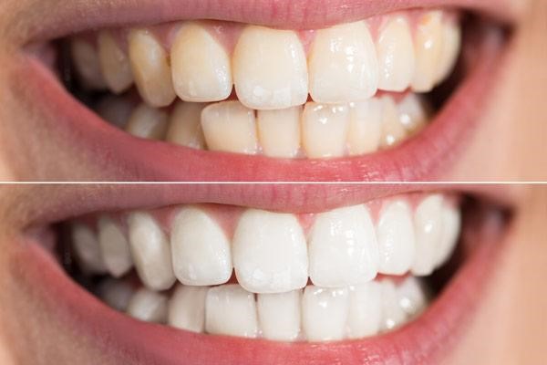 قیمت ژل سفید کننده دندان بلیچینگ هوم