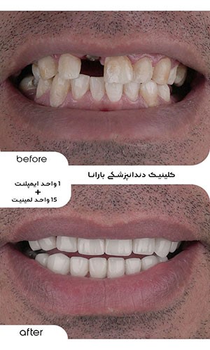 ایمپلنت و لمینت مشهد به صورت همزمان