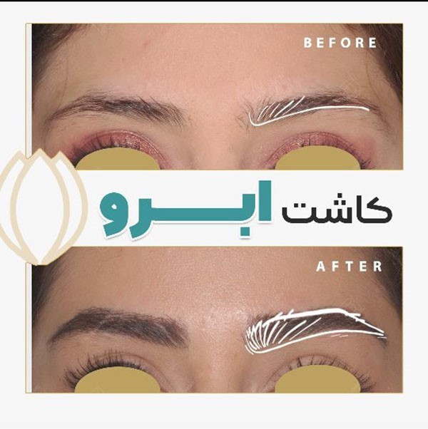بهترین کلینیک کاشت ابرو