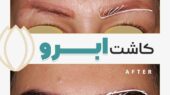 خدافظی با ابرو های کم پشت با کاشت ابرو