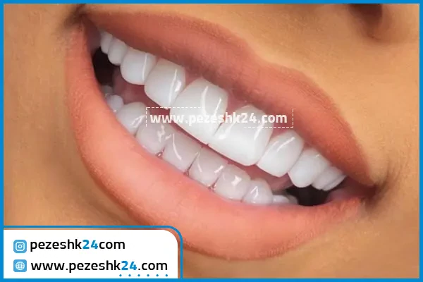 انواع لمینت سرامیکی دندان