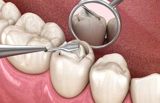قلم کامپوزیت دندانپزشکی
