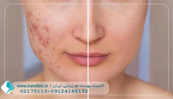 لیزر جای جوش کلینیک ایران