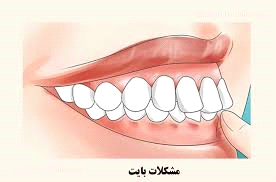 عمل جراحی فک بالا در چه مواردی توصیه می شود؟
