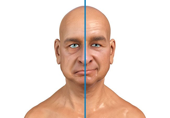 آیا میتوانم خطر فلج صورت خود را کاهش دهم؟