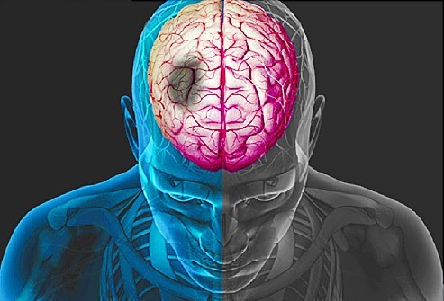 علت بروز سکته مغزی چیست