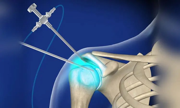 هزینه عمل شانه چقدر است؟