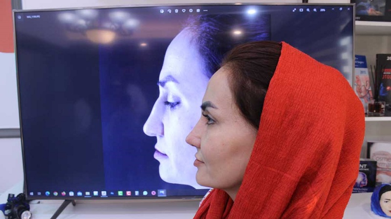 تا چه اندازه تورم بعد از جراحی بینی طبیعی و نرمال است