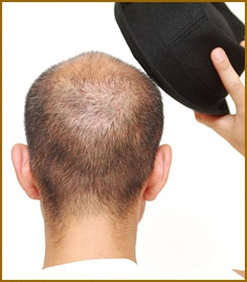 معایب استفاده از کلاه بعد از کاشت مو