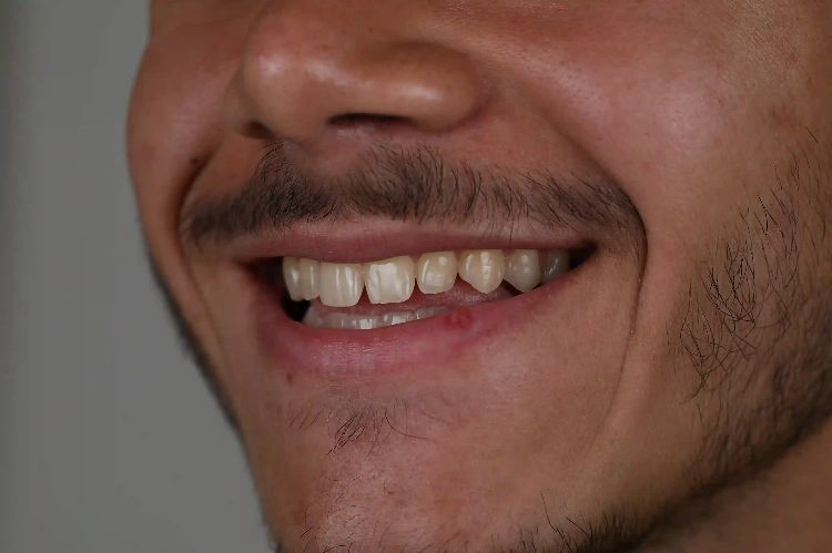 بهترین نوع لمینت