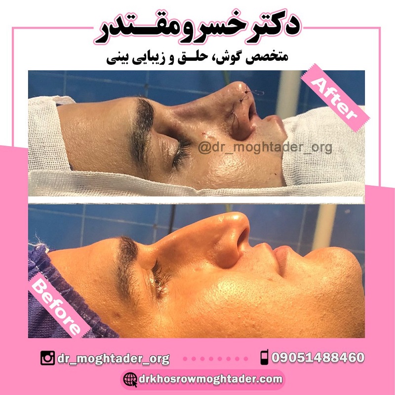 جراحی بینی استخوانی
