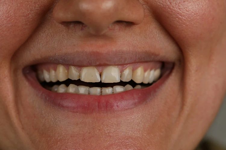 مراقبت‌ های بعد از لمینت