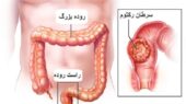 علائم و درمان سرطان رکتوم (سرطان راست روده)