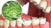 نقش میکروب‌های بیماری لثه در افزایش خطر سرطان سر و گردن