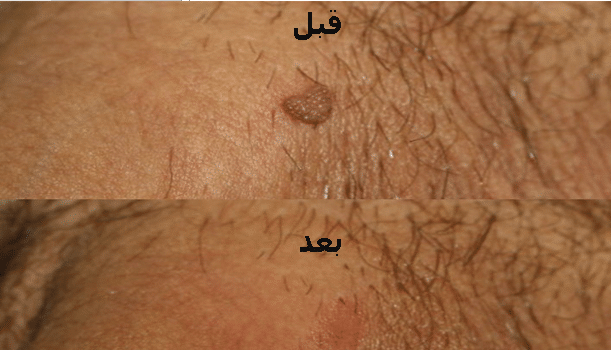 درمان زگیل تناسلی با لیزر