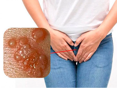 پیشگیری از ابتلا به زگیل تناسلی