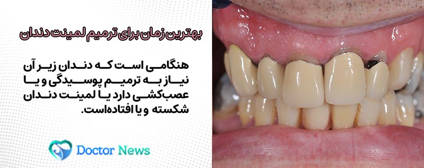 بهترین زمان تعویض لمینت دندان