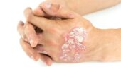 بیماری صدف چیست؟ علل، علائم و درمان