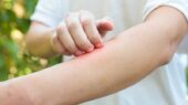 چگونه از خارش و التهاب پوستی در فصل بهار جلوگیری کنیم؟