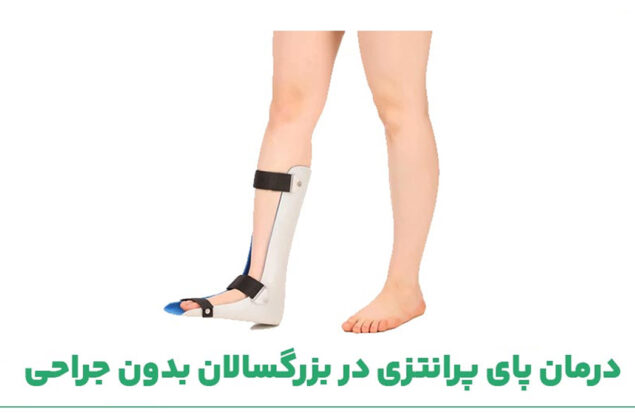 درمان پای پرانتزی در بزرگسالان بدون جراحی