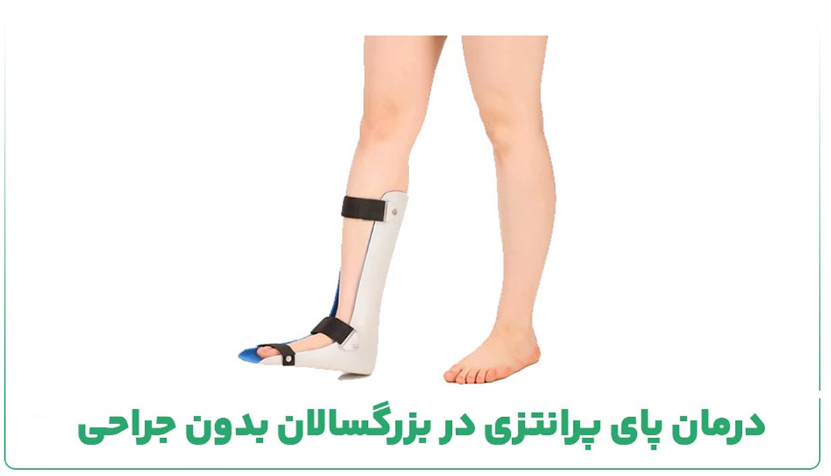 درمان پای پرانتزی در بزرگسالان بدون جراحی