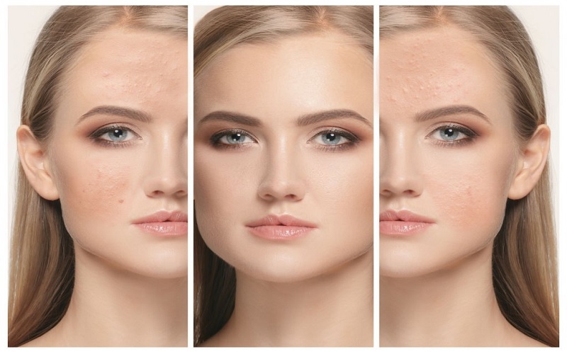 فیشیال پوست ترکیبی