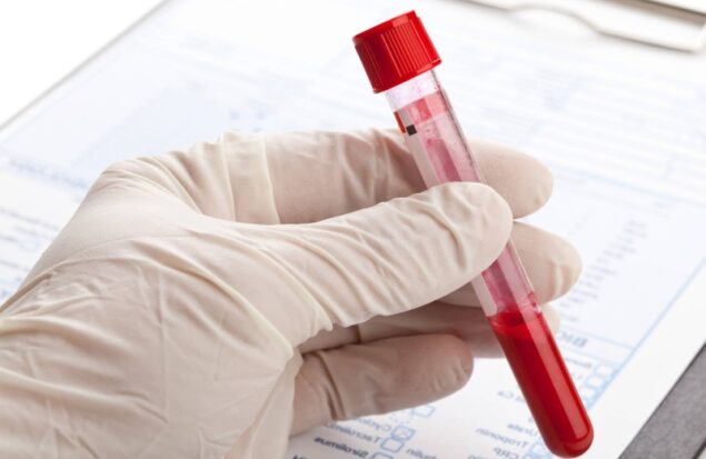 تشخیص زودهنگام سرطان سر و گردن با آزمایش خون نوین HPV-DeepSeek
