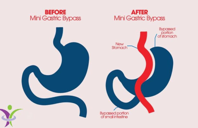عمل بای‌ پس معده چند ساعت طول می‌کشد