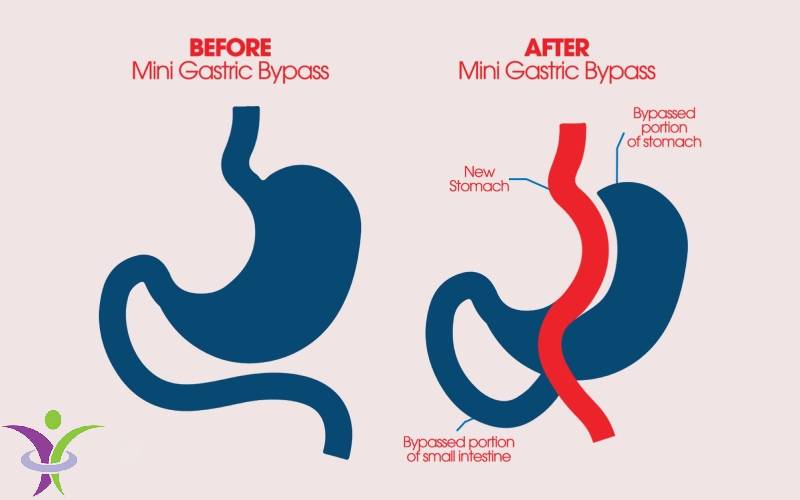 عمل بای‌ پس معده چند ساعت طول می‌کشد