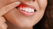 مطالعه تازه نشان می‌ دهد: التهاب لثه ممکن است به آسیب مغزی و سکته منجر شود