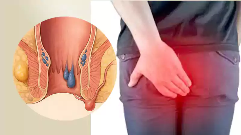 هموروئید خاموش