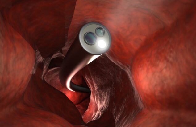 کلونوسکپی چیست و چگونه انجام می شود؟ هرآنچه باید درباره این آزمایش بدانید