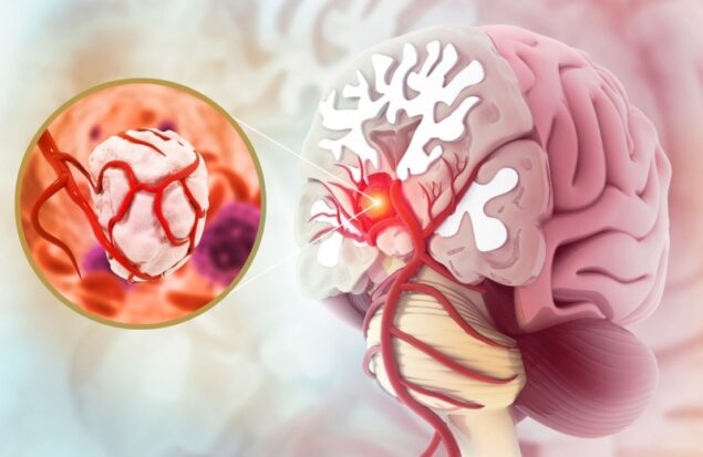 ۷ علامت نگران‌ کننده تومور مغزی که نباید نادیده گرفته شوند