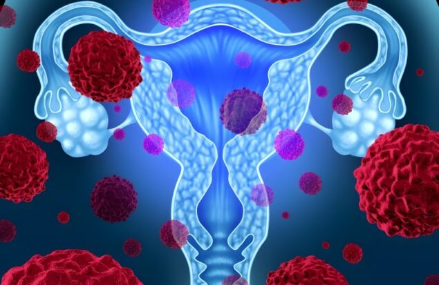 دستاورد جدید MIT در نبرد با سرطان تخمدان؛ نانو ذراتی که تومورها را نابود می‌ کنند