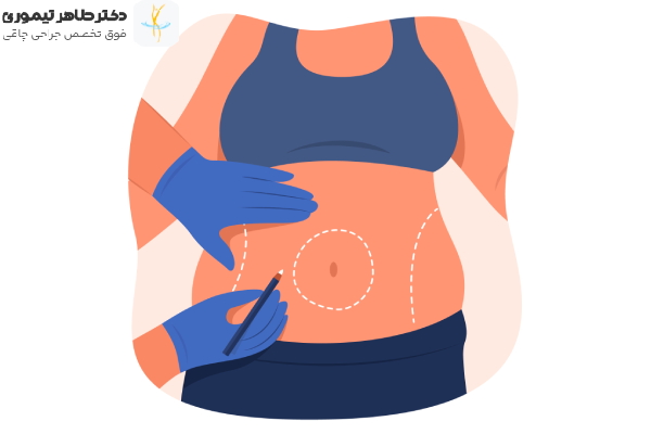 هزینه عمل اسلیو بهترین جراح اسلیو معده در تهران