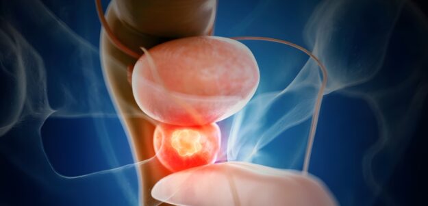 ترکیب دارویی نوین و هورمون‌ درمانی: کاهش بیش از ۴۰ درصدی مرگ ناشی از سرطان پروستات تهاجمی