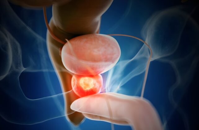 ترکیب دارویی نوین و هورمون‌ درمانی: کاهش بیش از ۴۰ درصدی مرگ ناشی از سرطان پروستات تهاجمی