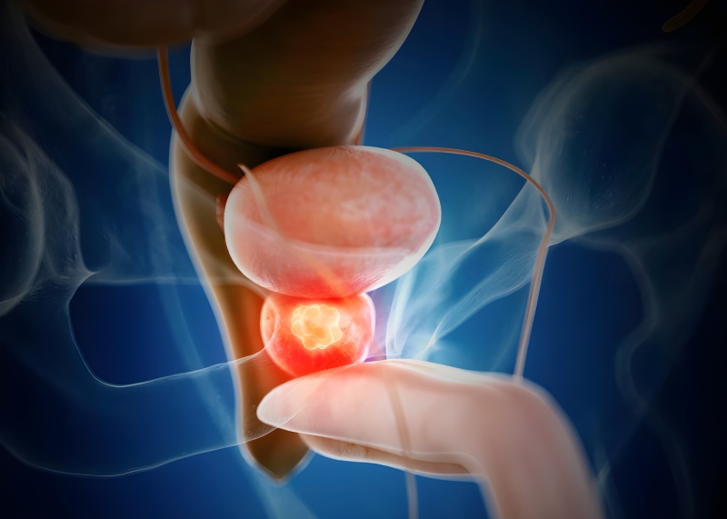 ترکیب دارویی نوین و هورمون‌ درمانی: کاهش بیش از ۴۰ درصدی مرگ ناشی از سرطان پروستات تهاجمی