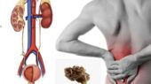 این علائم هشدار می‌دهند سنگ کلیه دارید