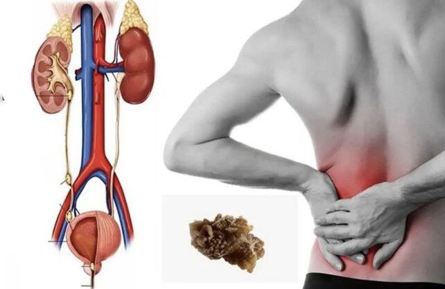 این علائم هشدار می‌دهند سنگ کلیه دارید