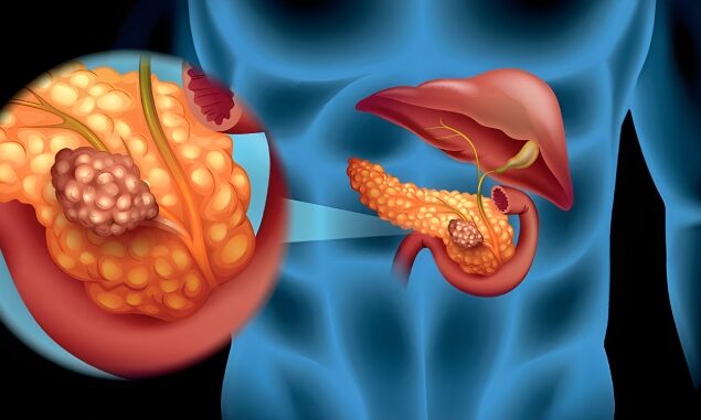 تحول در درمان مقاوم‌ ترین سرطان: پژوهش نوین سرطان پانکراس