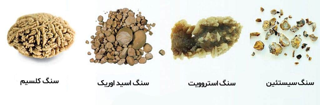 تشخیص نوع سنگ کلیه و اهمیت آن در درمان سنگ کلیه