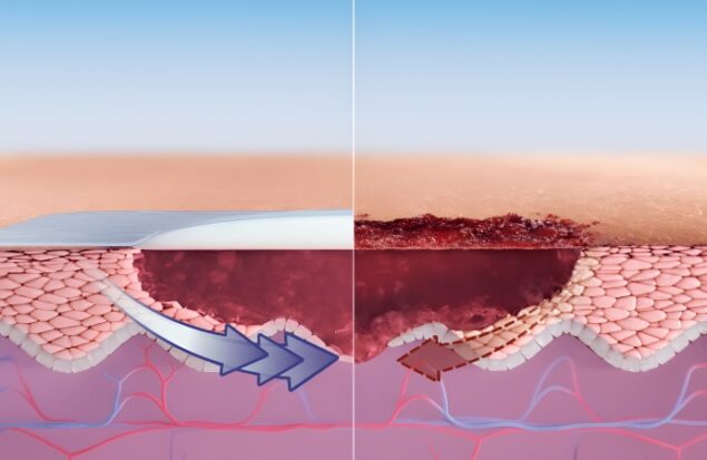 راهنمای کامل مراقبت از زخم‌ ها و جلوگیری از عفونت