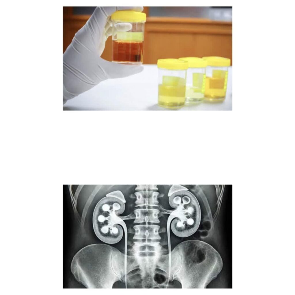 وجود خون در ادرار نشانه‌ای از سنگ کلیه